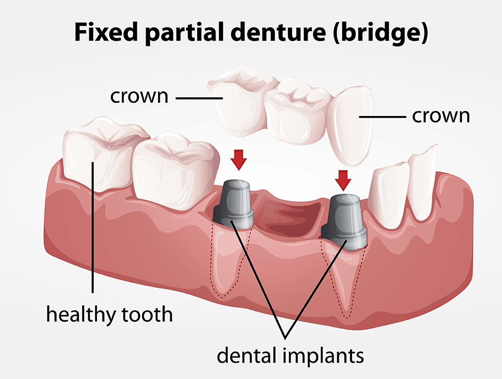 labelled diagram showing the implants, crowns and denture bridge