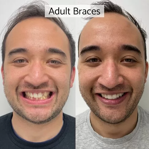 Braces In London - Adult Braces