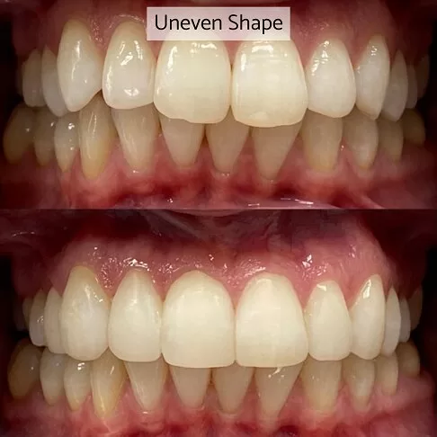 Cosmetic Dentist London - Before After Uneven Shape Of Teeth