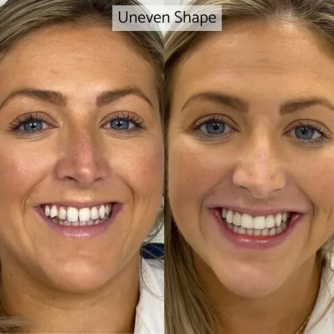 Cosmetic Dentist London - Before After Uneven Shape