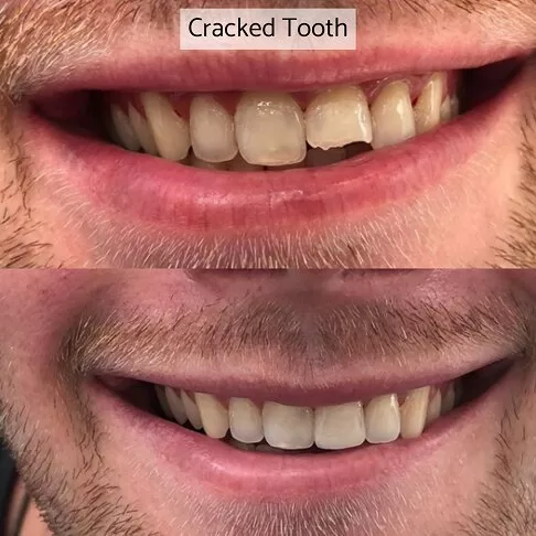 Cosmetic Dentist London - Chipped Cracked Tooth Corrected With Bonding