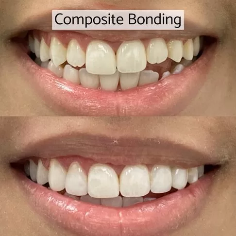 Cosmetic Dentist London - Composite Bonding