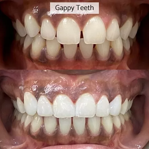 Cosmetic Dentist London - Gappy Teeth Fixed With Bonding