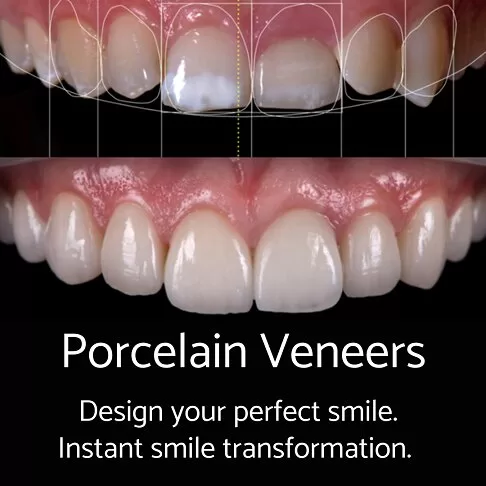 Cosmetic Dentist London - Porcelain Veneers