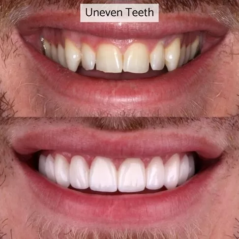 Cosmetic Dentist London - fixing uneven teeth with porcelain veneers