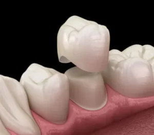 Dental crown placement on tooth illustration, showcasing Emergency Dentist Marble Arch W2’s restoration services