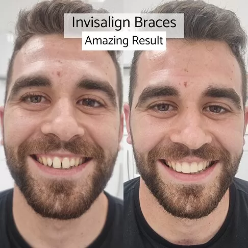 Invisalign Braces Result In London Waterloo And Marble Arch