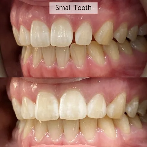 Composite Bonding Cost - Small Tooth Size