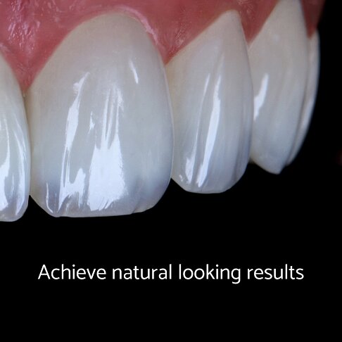 Achieve more natural looking results with layering technique for composite bonding