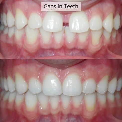 Before after case photo where Invisalign was used for closing teeth gaps 3