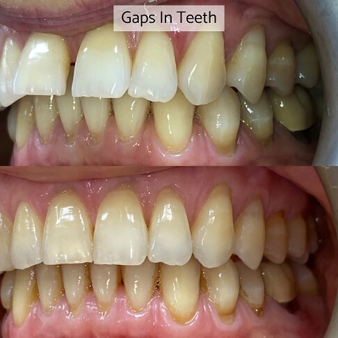 Before after photo of a case where Invisalign was used for closing teeth gaps 2