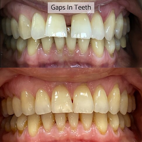 Before after photo of a case where Invisalign was used for closing teeth gaps 1