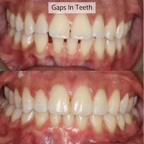 Before after photo of a case where Invisalign was used for closing teeth gaps on the lower arch