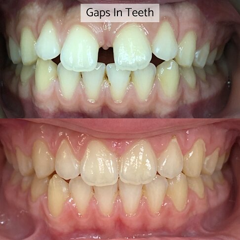 Before after photo of a case where Invisalign was used to close gaps between teeth 1