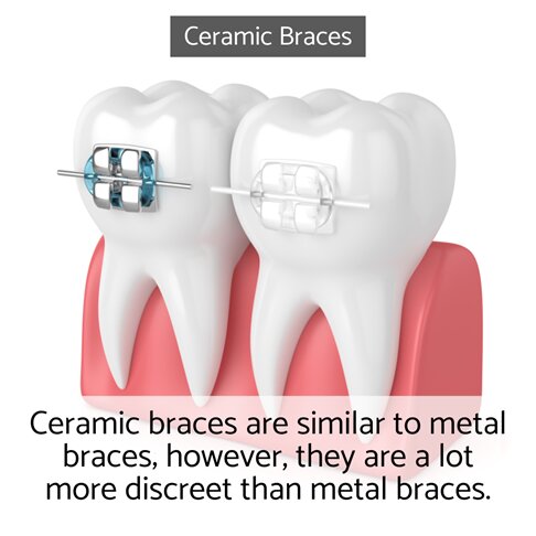 Ceramic braces are more discreet than traditional metal braces