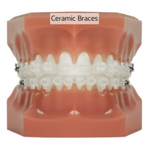 Ceramic braces cost in London