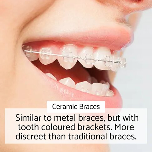 Ceramic braces system showing tooth coloured brackets