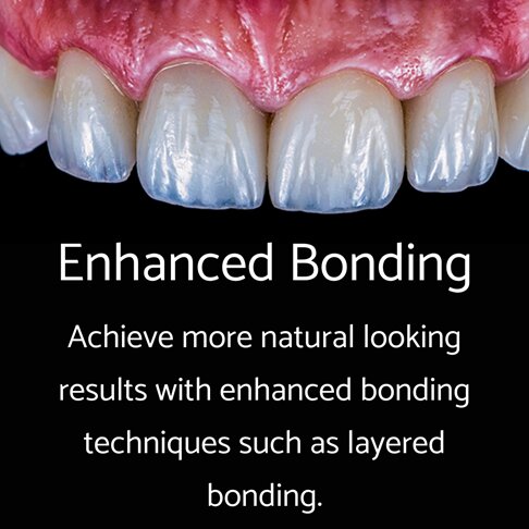 Composite Bonding - Enhanced Bonding Layered Technique