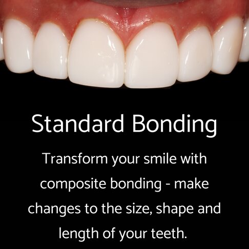 Composite Bonding - Standard Bonding Technique