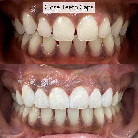 Composite bonding can be used to close teeth gaps