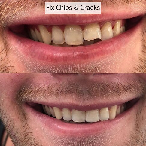 Composite bonding can be used to fix cracked teeth and chips