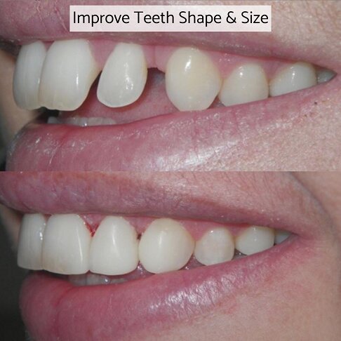 Composite bonding can be used to improve teeth shape and size