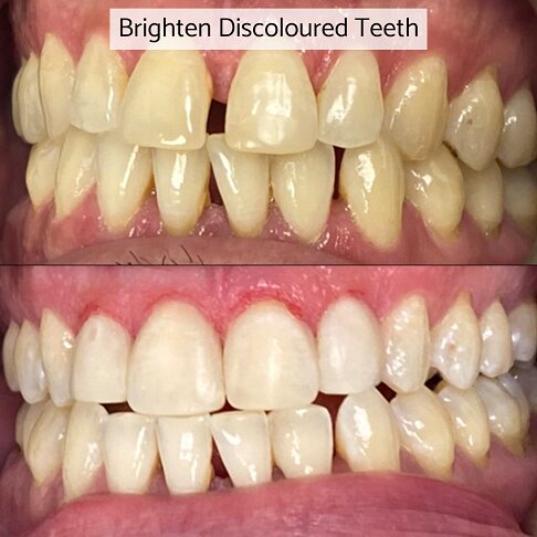 Composite bonding can be used to whiten discoloured teeth