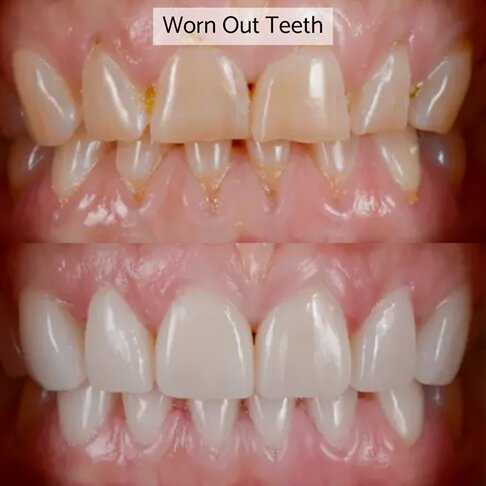 Composite bonding on worn out teeth in London