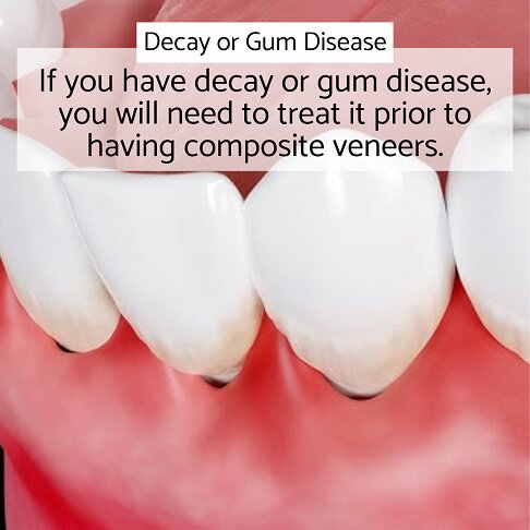 Composite veneers can only be had if you have good oral health