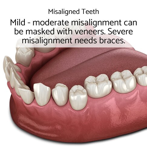 Composite veneers cannot treat severe teeth misalignment