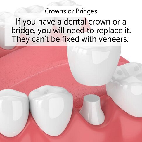 Crowns and bridges can't be fixed with composite veneers