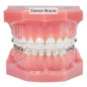 Damaon braces cost in London