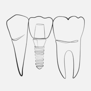 Dental implant treatment