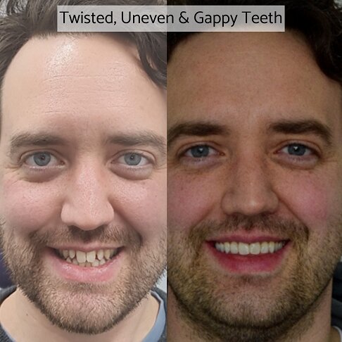 uneven and gappy teeth corrected with porcelain veneers