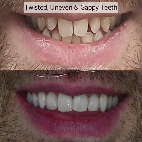 uneven and gappy teeth corrected with porcelain veneers close up