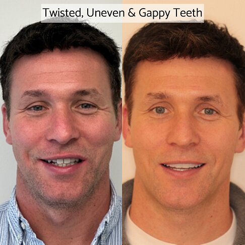 Twisted teeth corrected with porcelain veneers