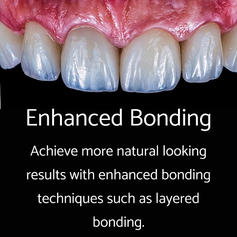 Enhanced Composite Bonding Advanced Layered Technique