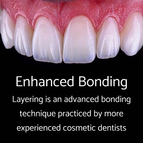 Enhanced composite bonding is a more advanced bonding technique