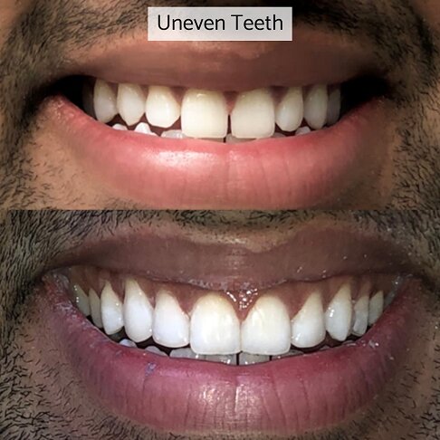 Gaps in teeth closed with composite bonding - before after 2