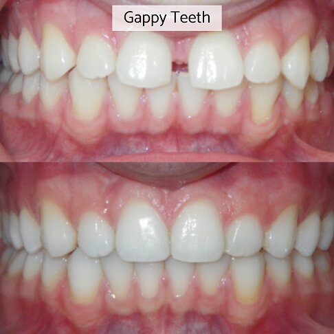 Gaps in teeth closed with composite bonding - before after 3