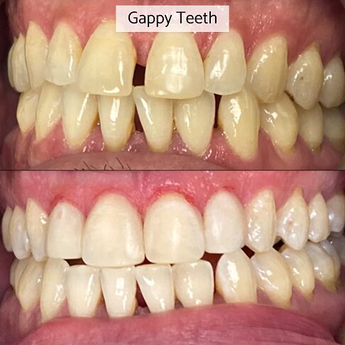 Gaps in teeth closed with composite bonding - before after 4