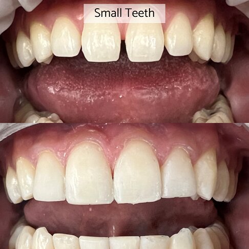 Gaps in teeth closed with composite bonding - before after 5