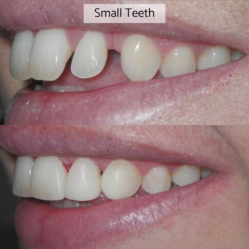 Gaps in teeth closed with composite bonding - before after 6