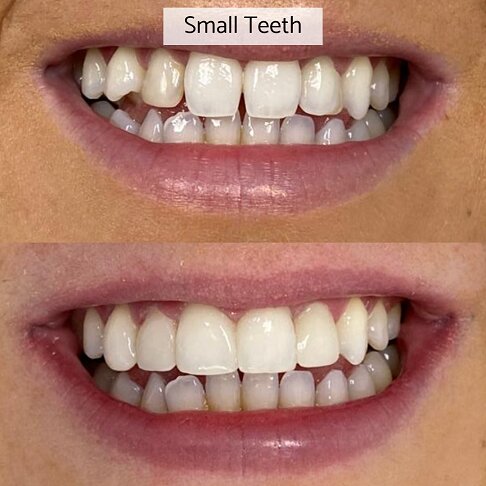 Gaps in teeth closed with composite bonding - before after