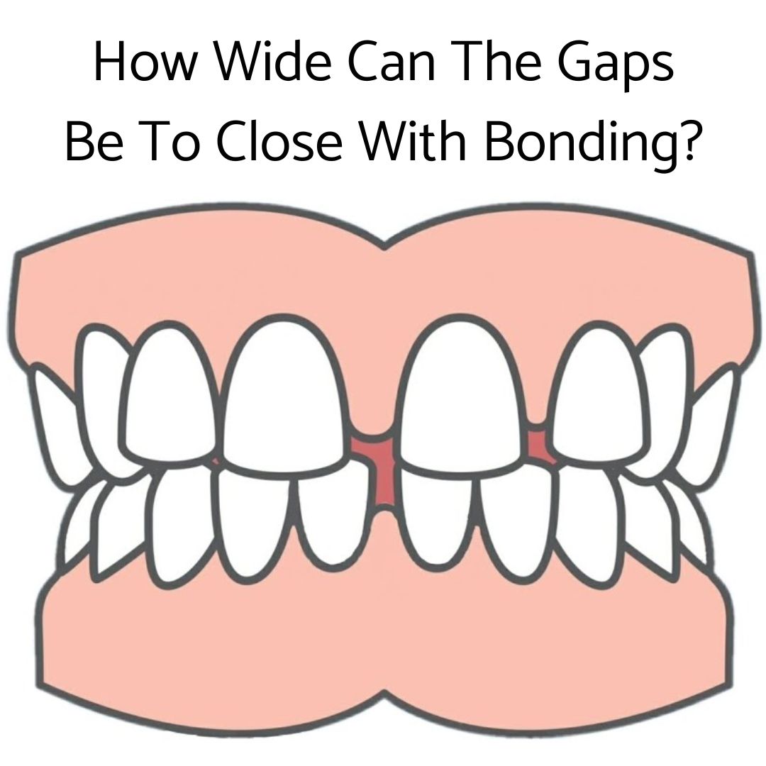 How Wide Can The Gaps Be To Close With Composite Bonding