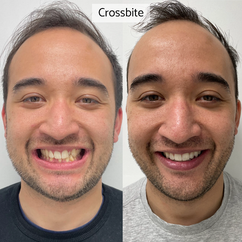 Invisalign review from older adults showing our before after results for a cross bite