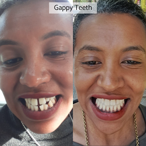 Invisalign review from older adults showing our before after results for a gappy smile