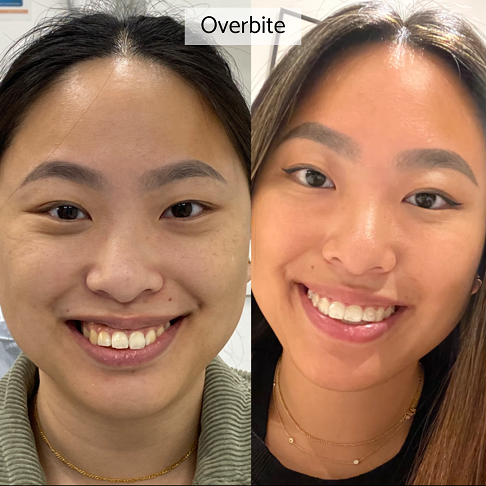 Invisalign review from older adults showing our before after results for an overbite