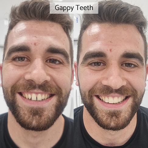 Invisalign review from older adults showing our before after results for gapped teeth