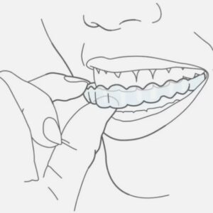 Invisalign treatment